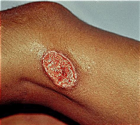 Cutaneous leishmaniasis: An ulcerated plaque with indurated border ...