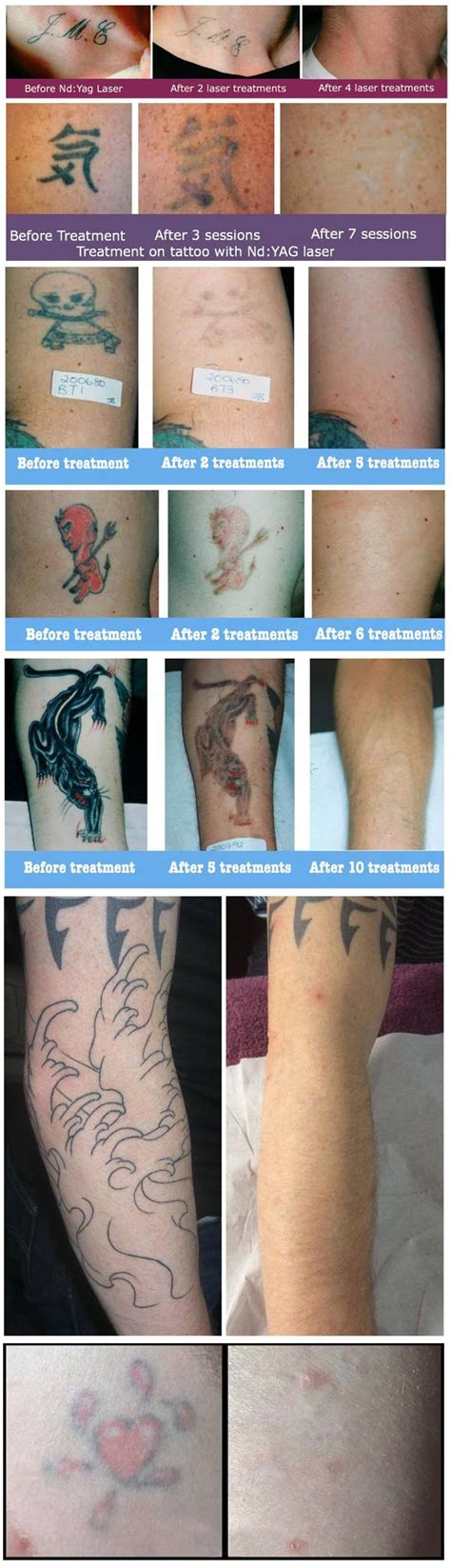 Laser tattoo removal treatment in Worcestershire - Outline Clinic Droitwich