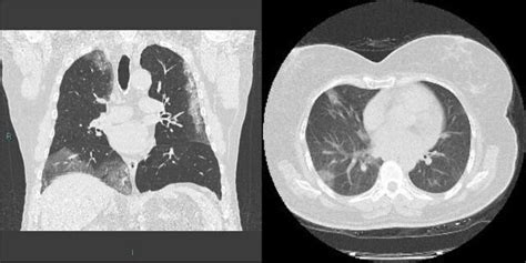 COVID-19 (Coronavirus) Diagnosis, Chest X-ray and CT Scan