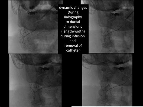 Submandibular Sialogram with Stricture Showing Dynamic Changes to Duct ...