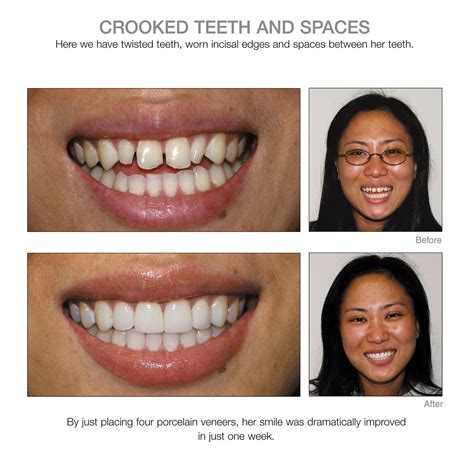 Crooked Teeth Before And After Veneers - Teeth Poster