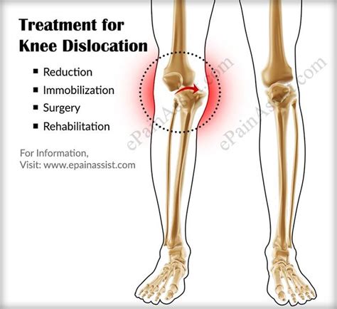 Pin by great wolf on "Κnee dislocation" | Knee dislocation, Dislocation, Treatment