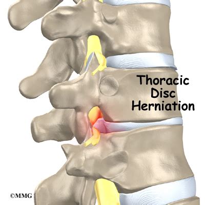 Thoracic Disc Herniation | Orthogate