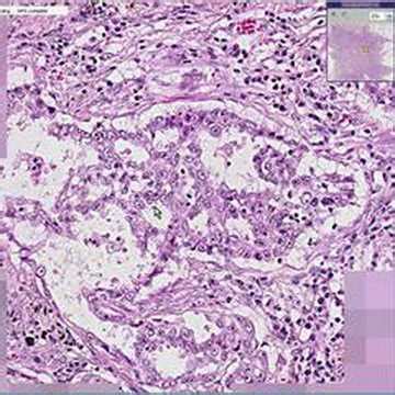 Histopathology Lung-- Adenocarcinoma - YouTube