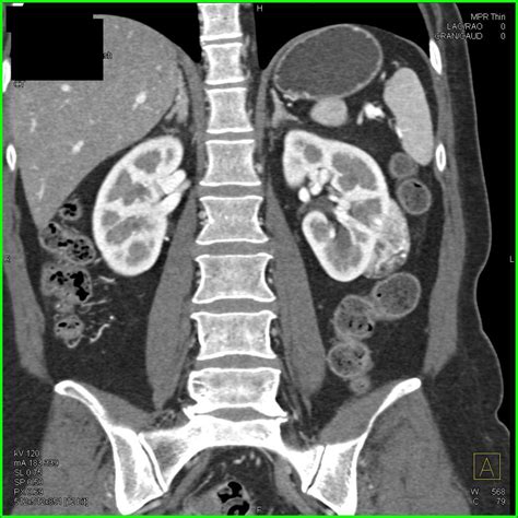 Left Renal Angiomyolipoma with Minimal Fat - Kidney Case Studies - CTisus CT Scanning