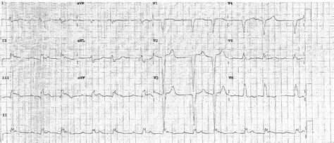 Sgarbossa Criteria • LITFL • ECG Library Diagnosis