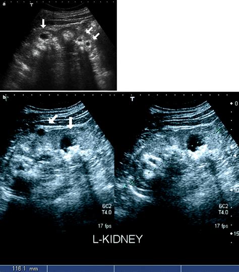 Cystic Diseases of the Kidney | Radiology Key