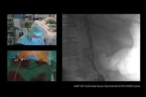 GORE® TAG® Conformable Thoracic Stent Graft with ACTIVE CONTROL System - Videos | Gore Medical ...