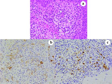 Case 3. Skin lesions consist of granulomatous lesions in the dermis ...