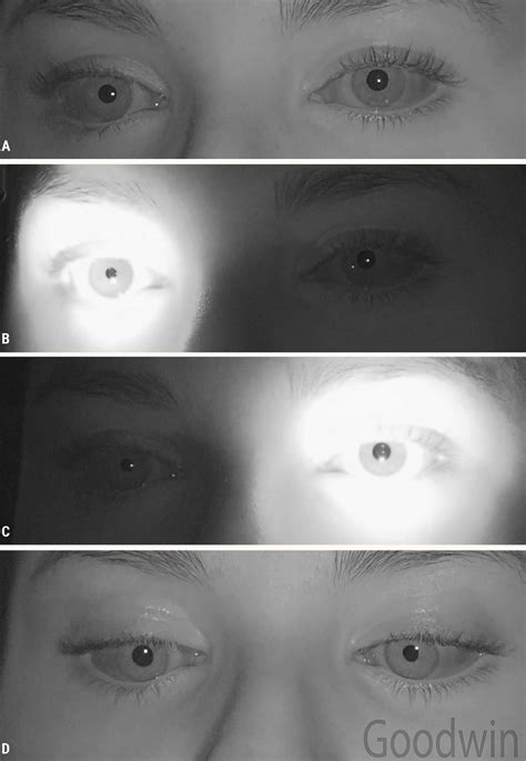 Lesson: Evaluation and Diagnosis of Pupil Disorders