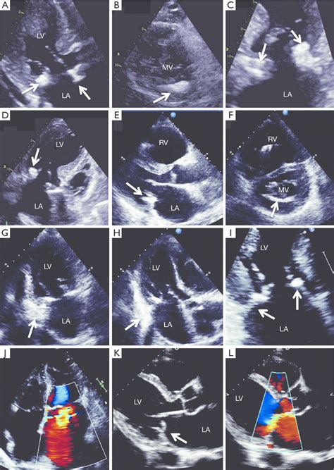 Four different examples of patients with mitral annular calcification ...