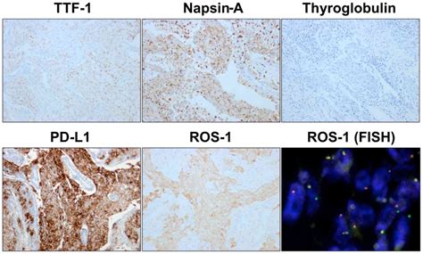 ROS1‑rearranged high‑PD‑L1‑expressing lung adenocarcinoma manifesting as mediastinal tumor: A ...