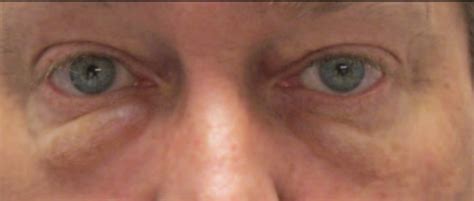 Under-Eye Filler – Adam Scheiner MD