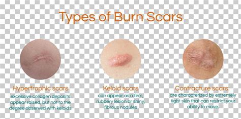 Burn Scar Contracture Hypertrophic Scar Keloid PNG, Clipart, Acne, Aloe ...