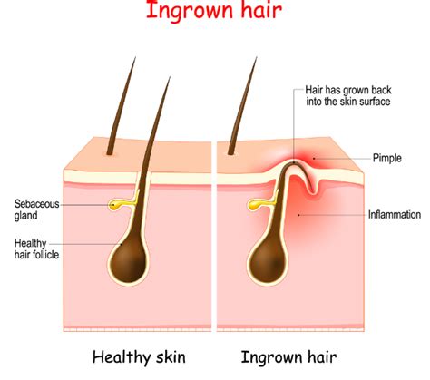 Ingrown Hairs: Causes,Treatment & Prevention