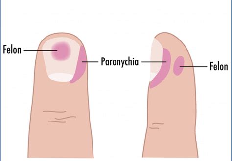 Paronychia Vs Felon