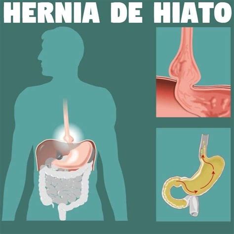 ¿Qué síntomas tiene la hernia de hiato? | Herbolario Saber y vida