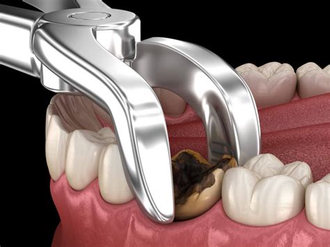 Learn The Aftercare Instructions For Tooth Extractions | Voss Dental - Oral Surgery | Implant