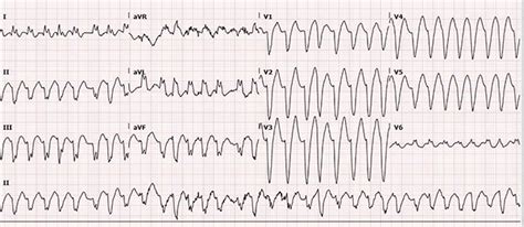 ECG Challenge: April 2018 EMRA