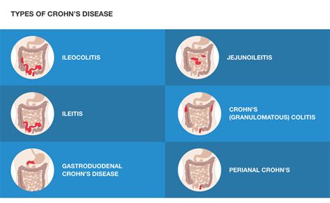 Different locations of Crohn's disease | IBD Relief
