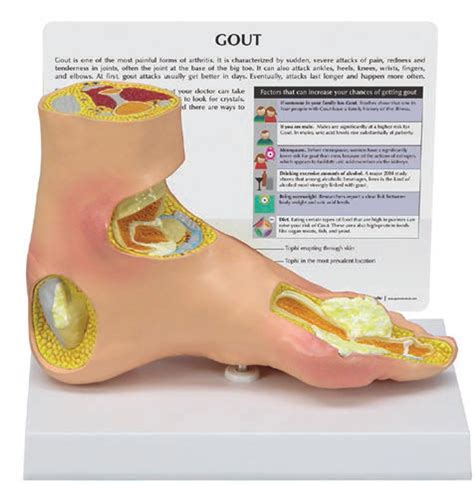 Gout Foot Model - Clinical Charts and Supplies