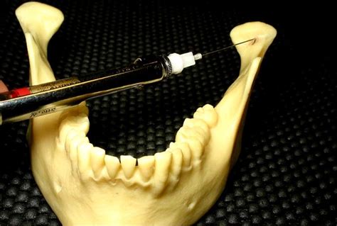 PDF: Efficacy of Gow-Gates Mandibular Nerve Block for The Extraction of Mandibular Molars