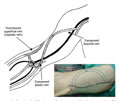 Figure 1 from Combined simultaneous basilic and brachial vein transposition. A new technique to ...