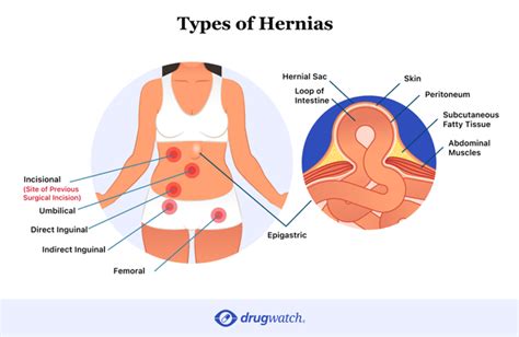 Hernia Mesh Complications: Long-Term Side Effects & Problems