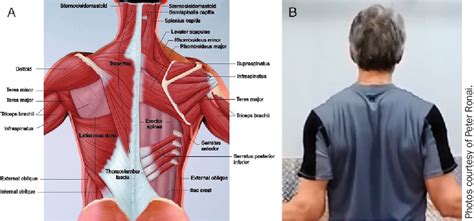 Figure 1 from Bilateral Scapular Retraction and Shoulder External Rotation with Resistance Bands ...