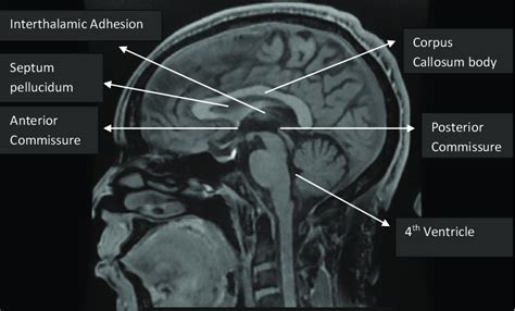 Mid-sagittal brain MRI showing the corpus callosum. | Download Scientific Diagram