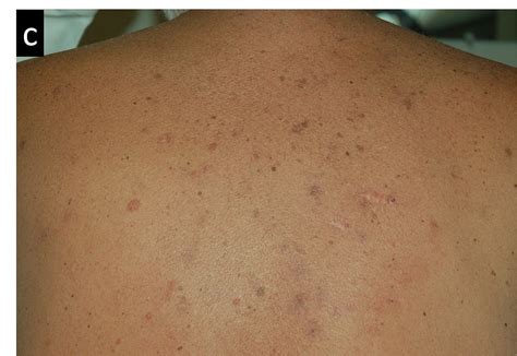 Cureus | Secondary Cutaneous Involvement in Follicular Diffuse Lymphoma ...