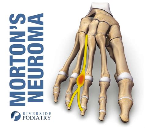 Morton’s neuroma - Riverside Podiatry