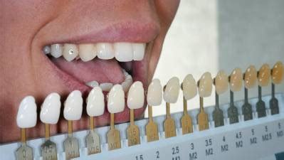 Teeth Color Chart and Natural Tooth Shade - Oral Health