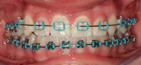 Braces Colours - Show off your personality with colour!