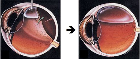 Retinal Detachment - The Retina Group