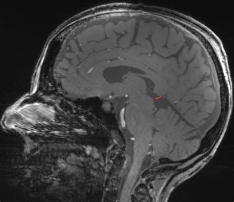 Colliculus superior - Ars Neurochirurgica