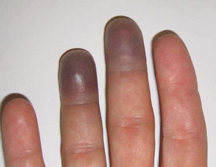 Fingertips Are Purple: Causes and Dealing Ways | Just-Health.net