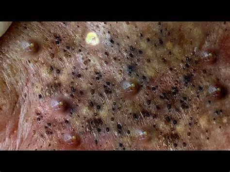 BLACKHEAD PIMPLES REMOVAL OF THE ELDERLY IN THAI NGUYEN - YouTube | Big blackhead, Blackheads ...