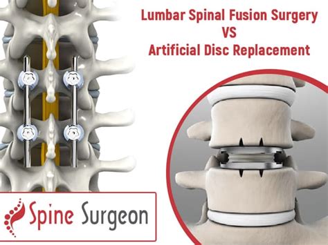 Lumbar Spinal Fusion Surgery VS Artificial Disc Replacement | Spine Surgeon