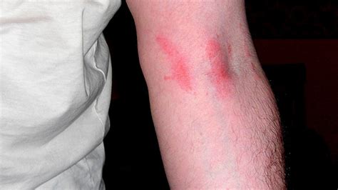 Poison Sumac: Rash, Pictures, and Treatment