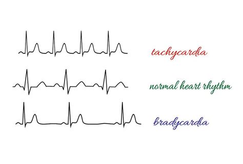 Junctional Rhythm - The Definitive Guide | Biology Dictionary