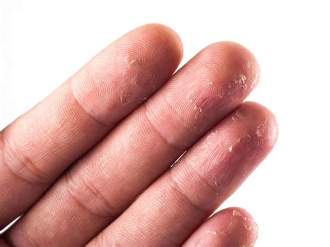 Skin peeling on fingertips: 10 causes