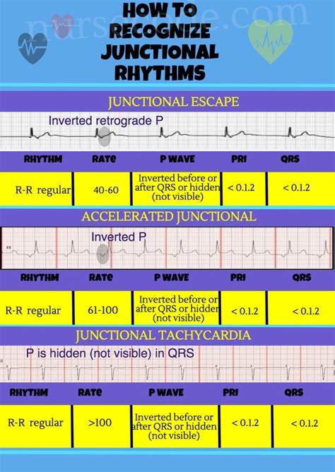 Junctional Rhythm InfoGraphic - nursecode.com | Icu nursing, Cardiology nursing, Paramedic school