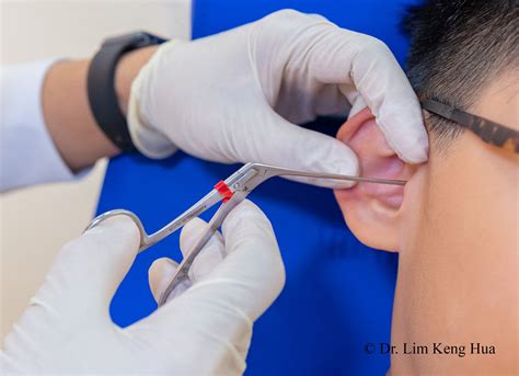 Ear Wax - Dr KH Lim ENT Clinic