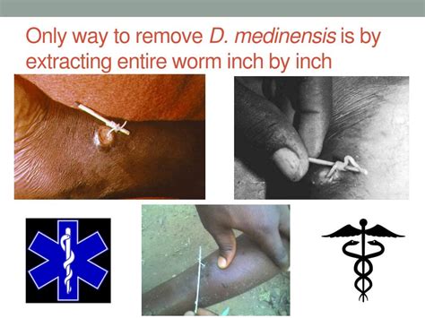 PPT - Dracunculiasis (Guinea Worm Disease) PowerPoint Presentation, free download - ID:3066565