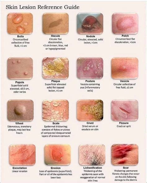 Common Skin Lesions Chart