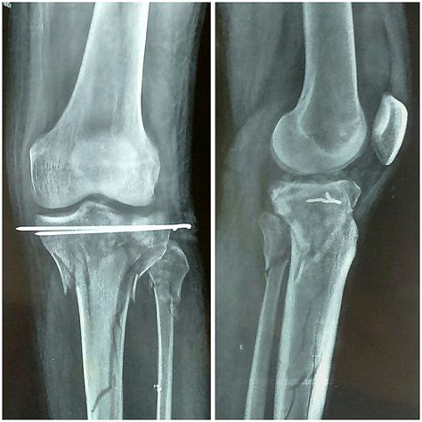 Cureus | Minimally Invasive Treatment of a Complex Tibial Plateau ...