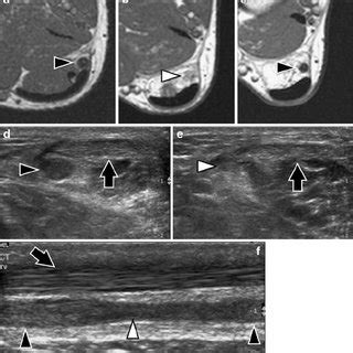 (PDF) Isolated tear of the plantaris tendon: Ultrasound and MRI appearance