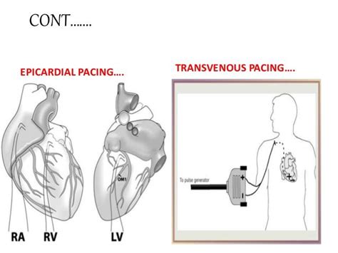 Pin by nonas arc on Epicardial pacing wires