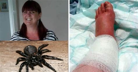 WARNING - GRAPHIC CONTENT: Woman Hospitalized TWICE In A Year After Horrific Spider Bites ...